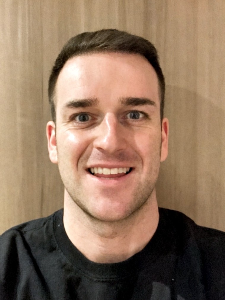 Hairline restoration result