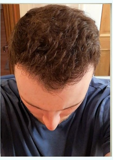 Crown restoration result