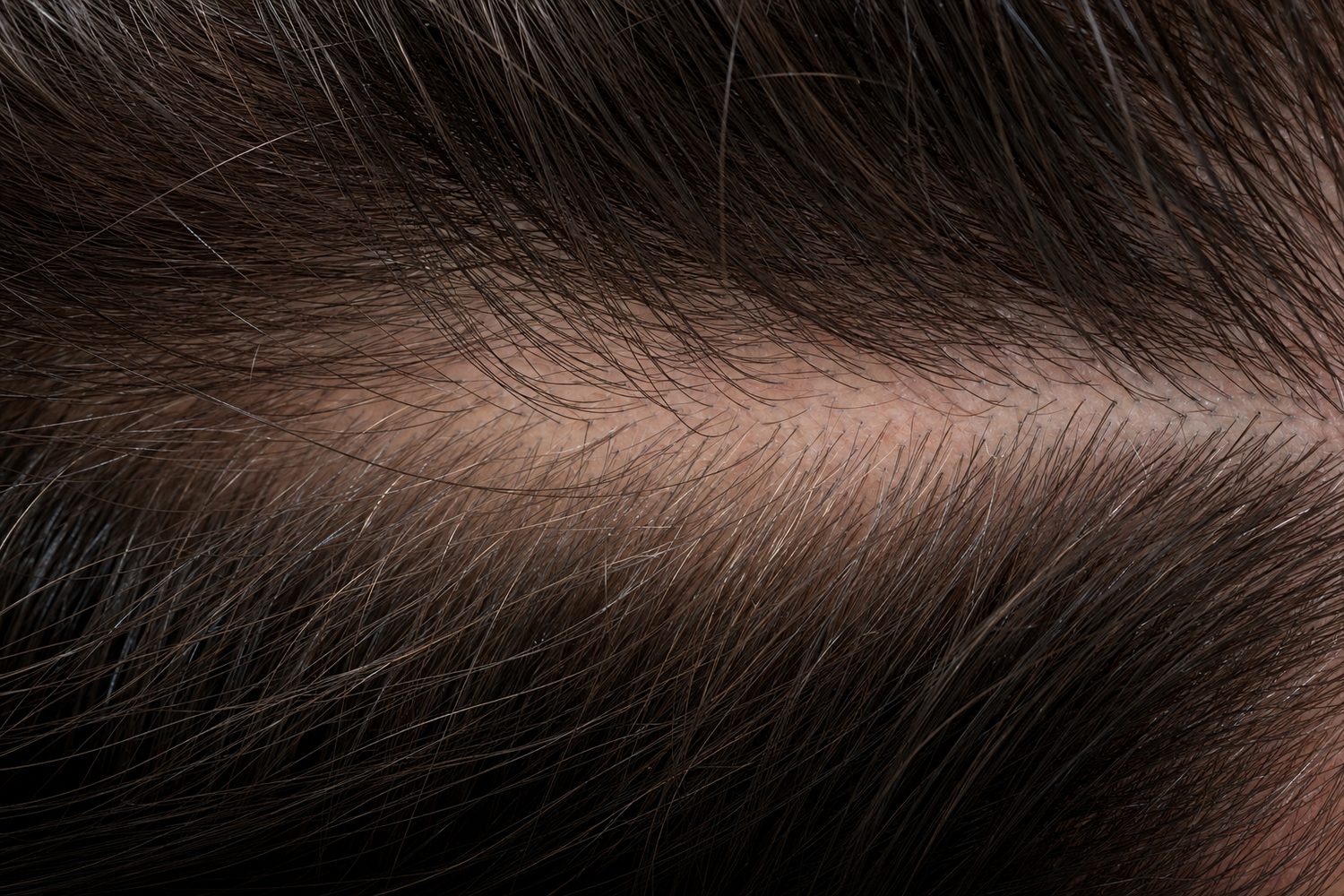 Terminal and miniaturised hairs along a parting — the texture of early pattern loss