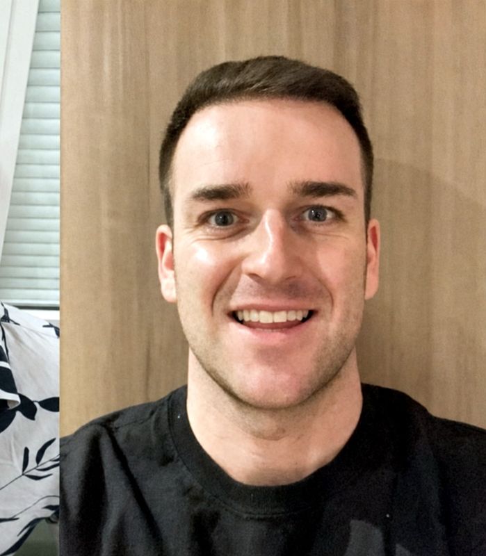 Hairline restoration — after