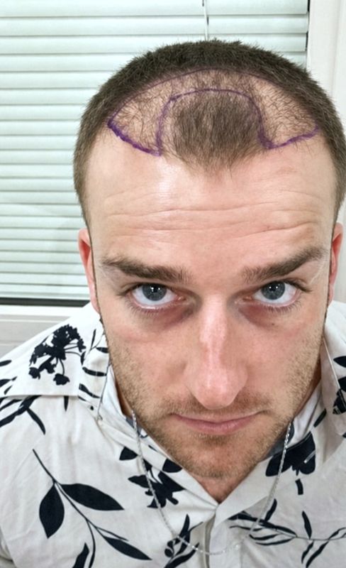 Hairline restoration — before