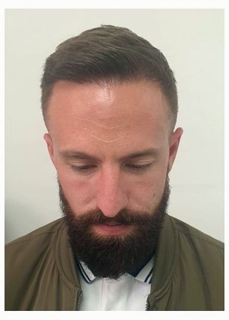 Mid-scalp density — after