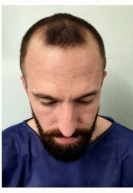 Mid-scalp density — before
