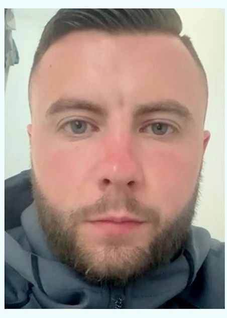Beard transplant — after
