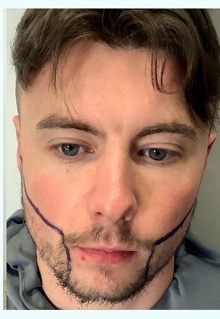 Beard transplant — before