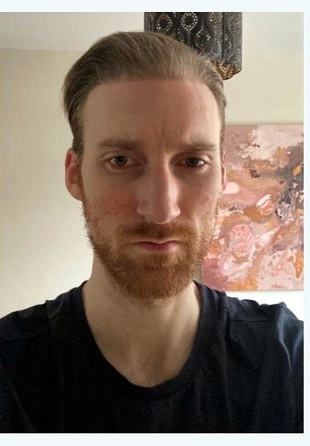 Hairline restoration — after