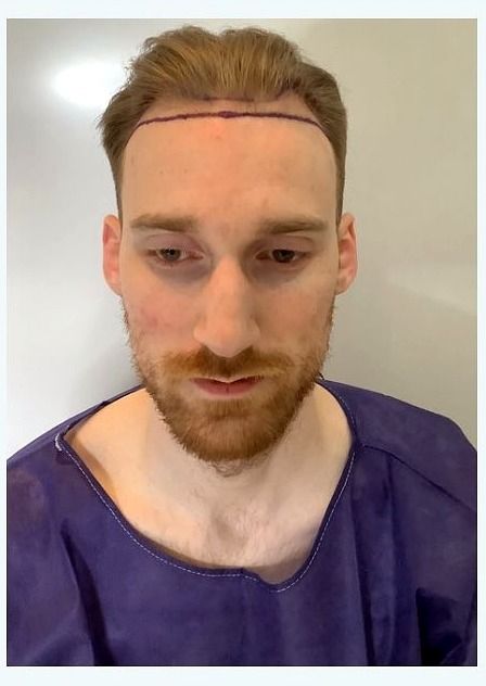 Hairline restoration — before