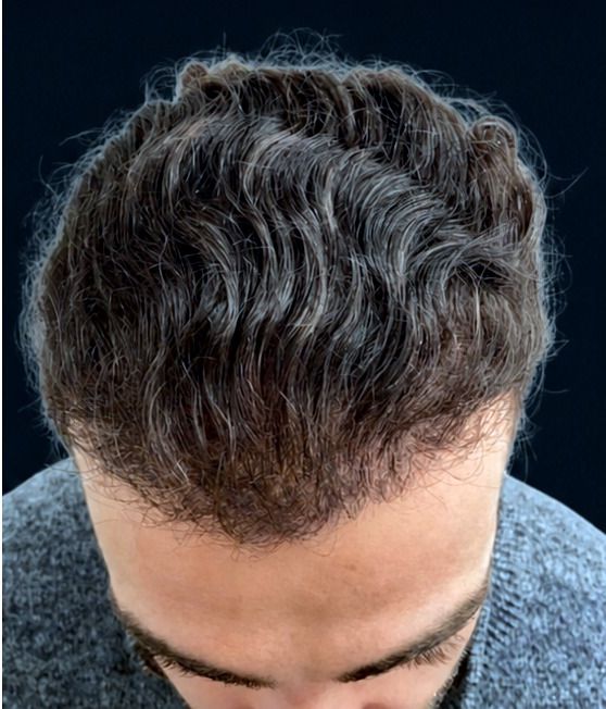 Full-scalp density — after