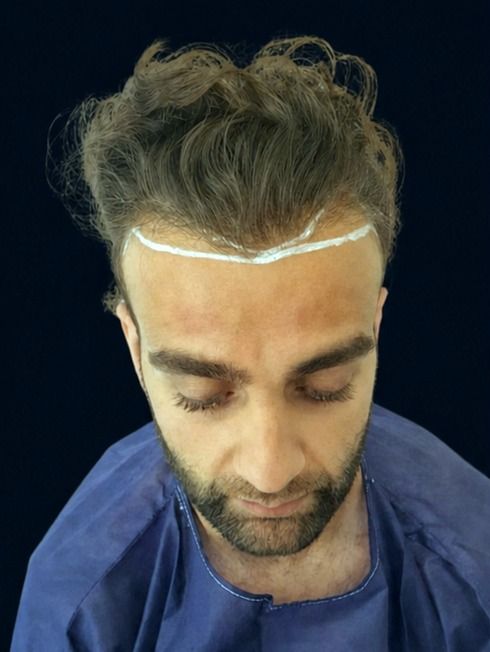 Full-scalp density — before