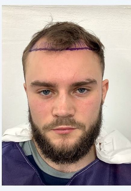 Hairline and temples — before