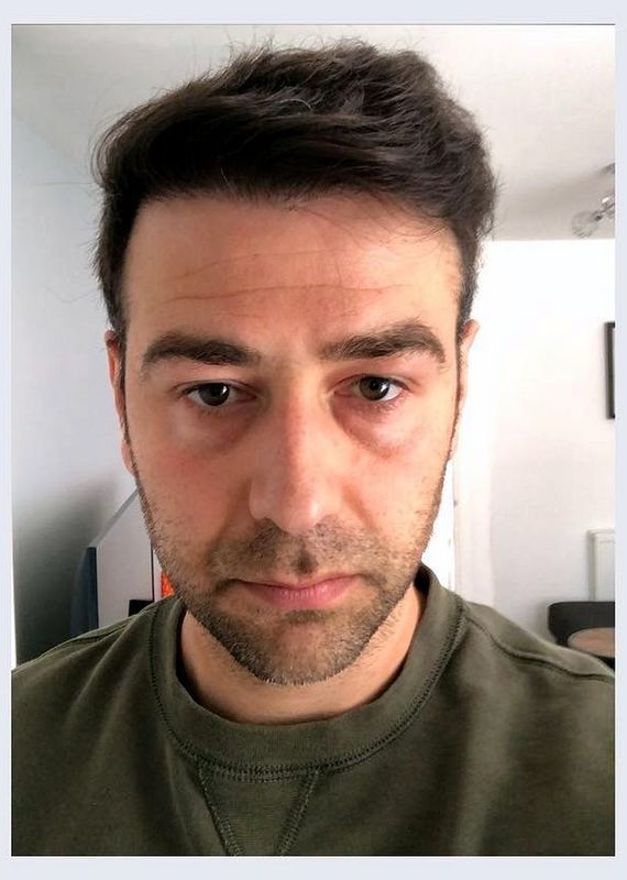 Hairline redesign — after