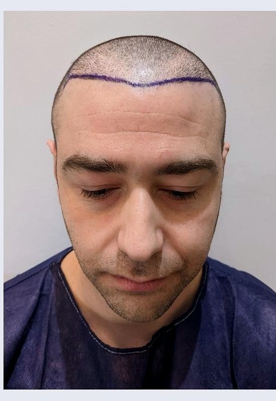 Hairline redesign — before