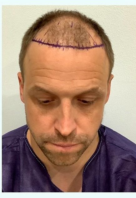 Frontal restoration — before