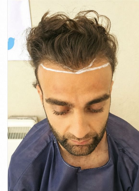 Frontal and mid-scalp — before