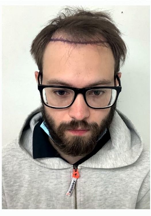 Hairline restoration — before