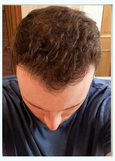 Crown restoration — after
