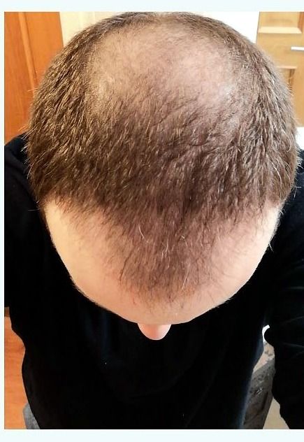 Crown restoration — before