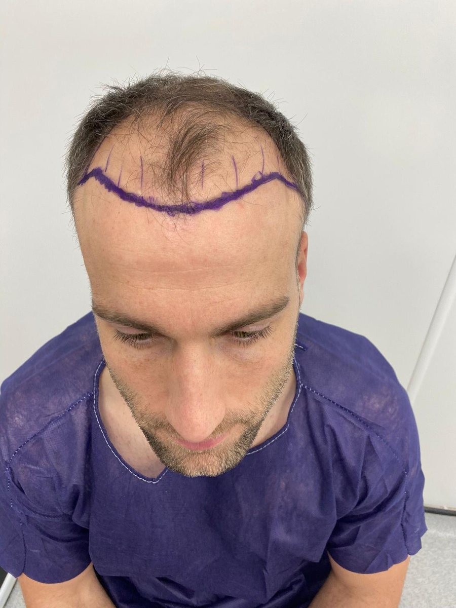Hairline design marked before FUE surgery, front view