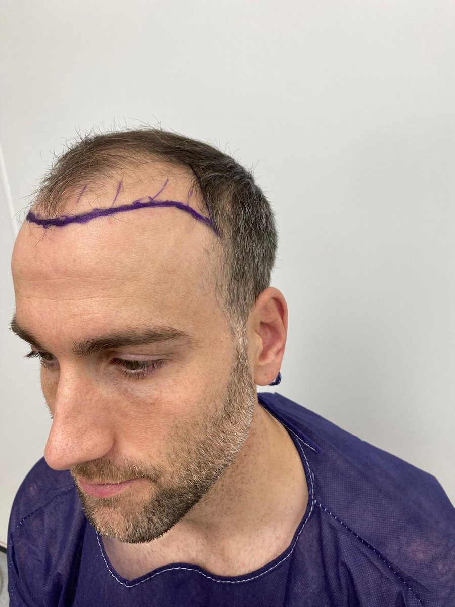 Hairline design marked before FUE surgery, side profile