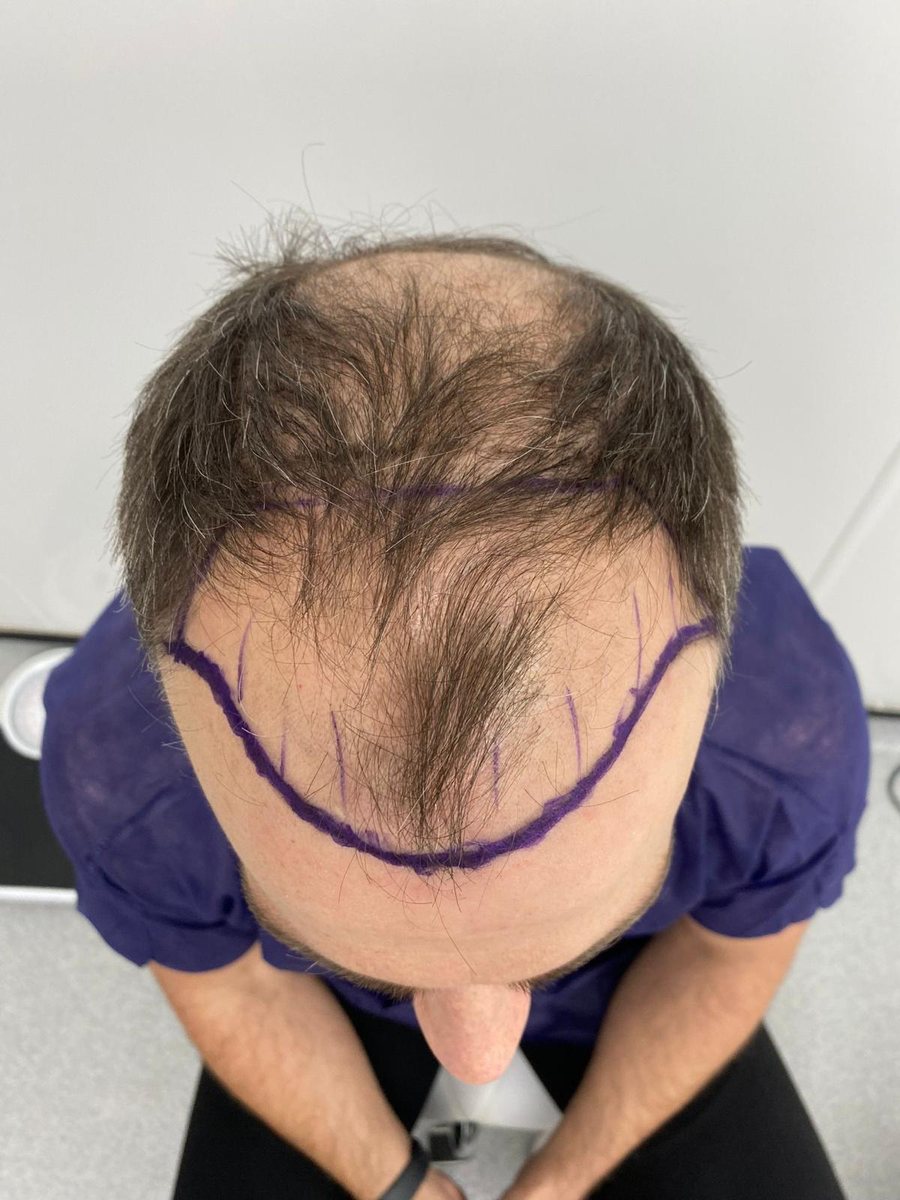 Hairline design marked before FUE surgery, viewed from above
