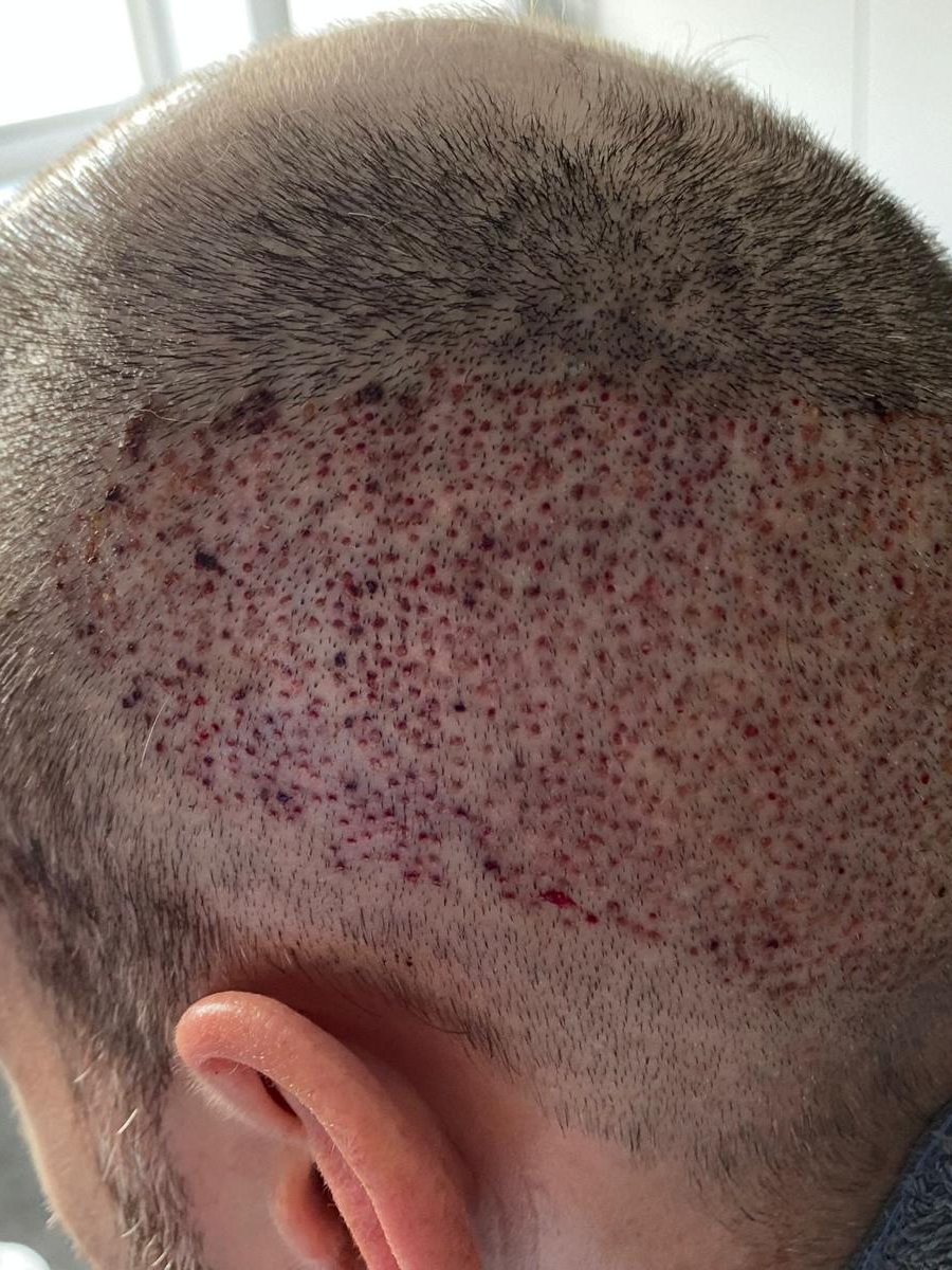 Recipient area immediately after FUE surgery