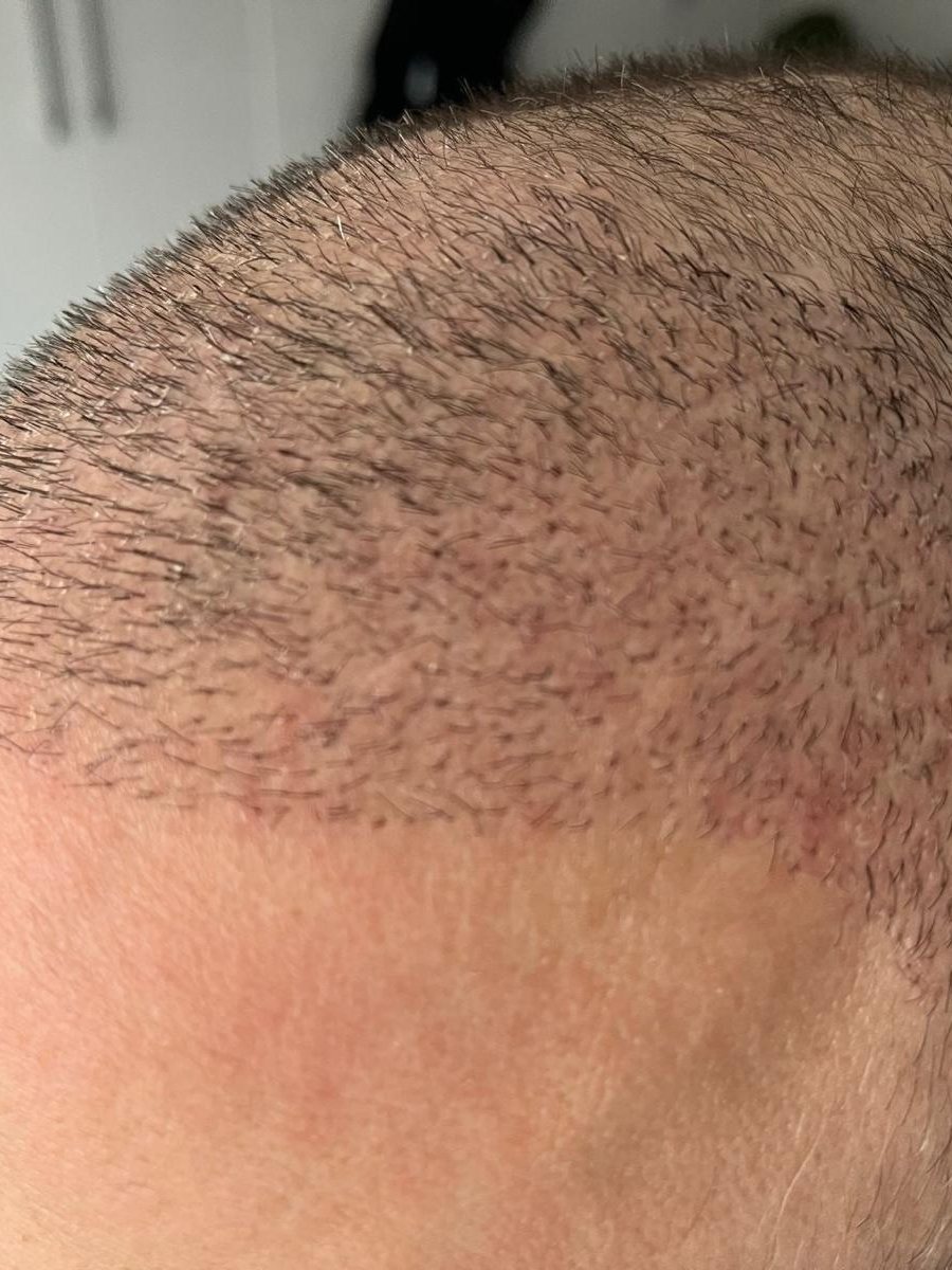 Scalp healing weeks after FUE surgery with early regrowth
