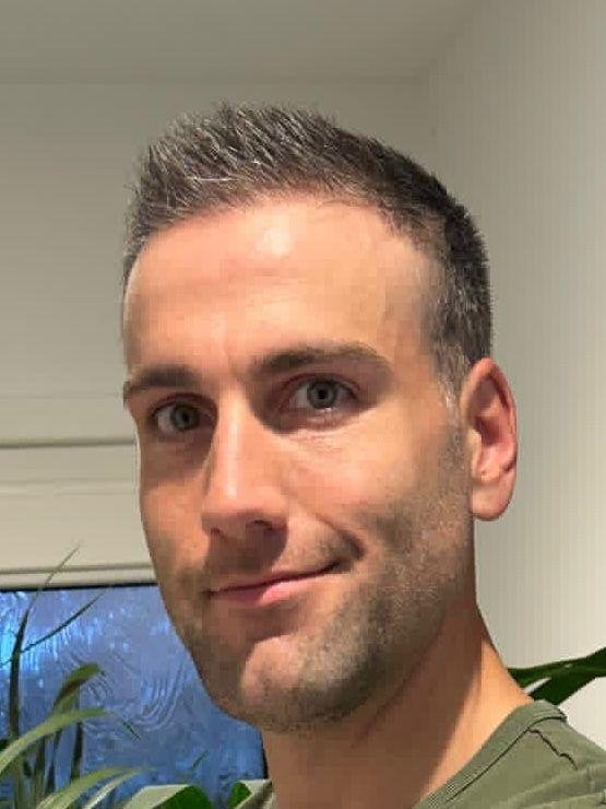 Grown hair transplant result, front view