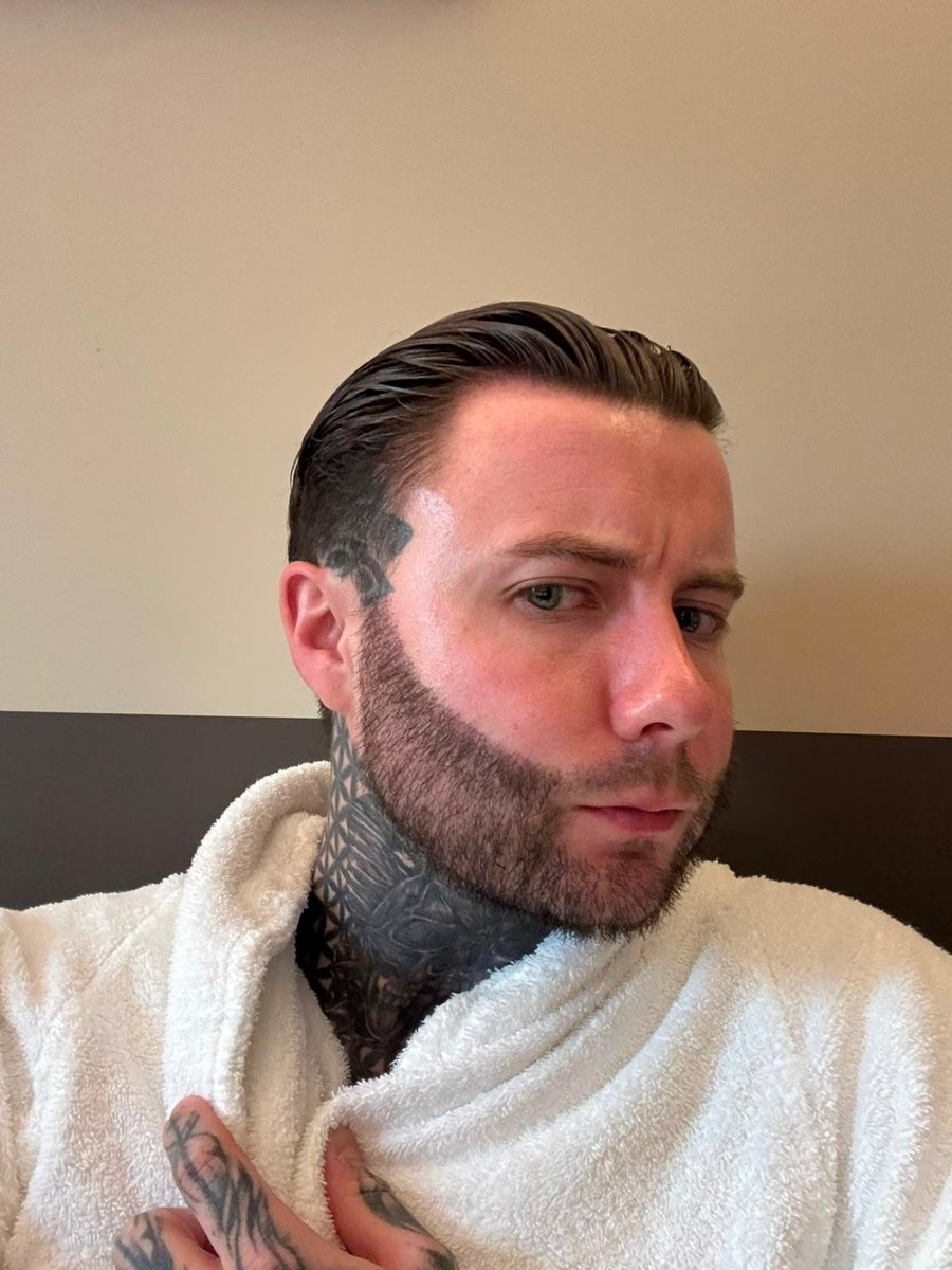 Grown hair transplant result, side profile