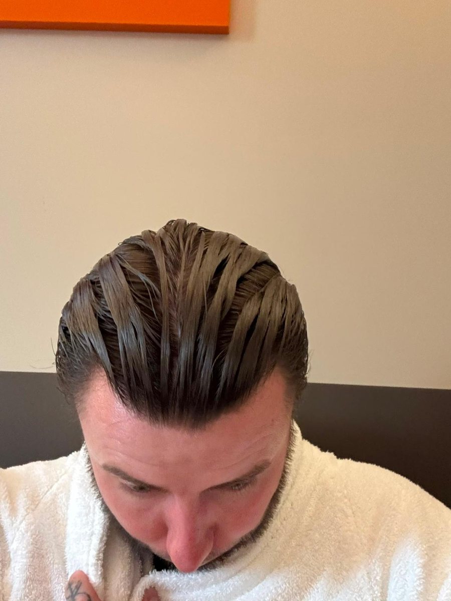 Grown hair transplant result, density from above