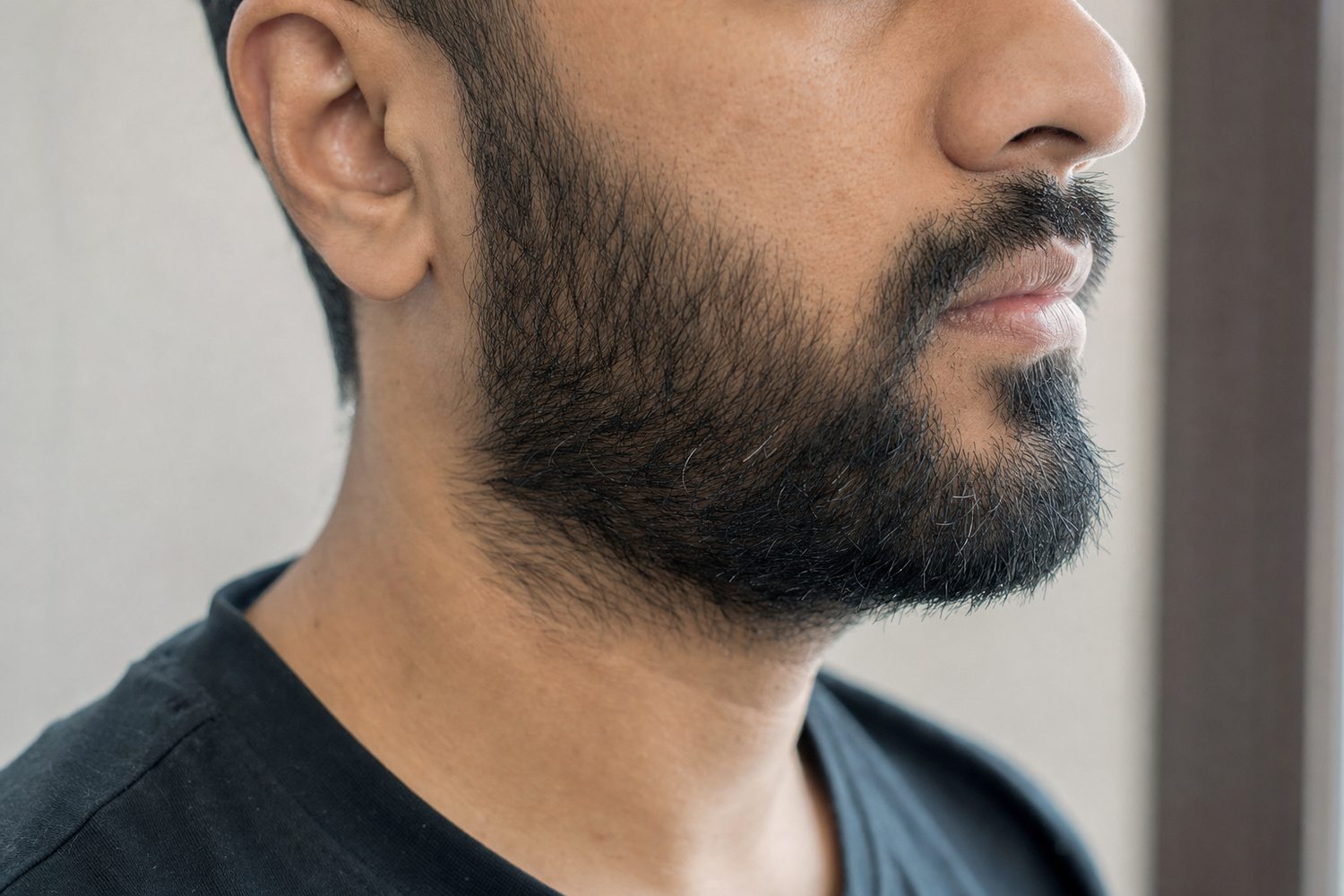 A graft placed into the beard line (illustrative)