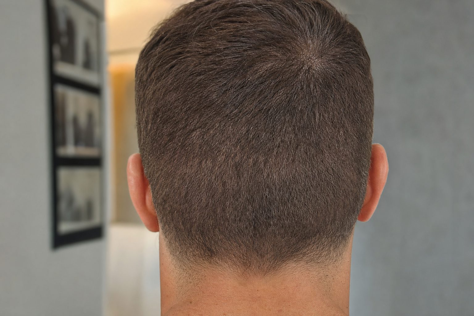 A healed donor area several months after FUE, worn short