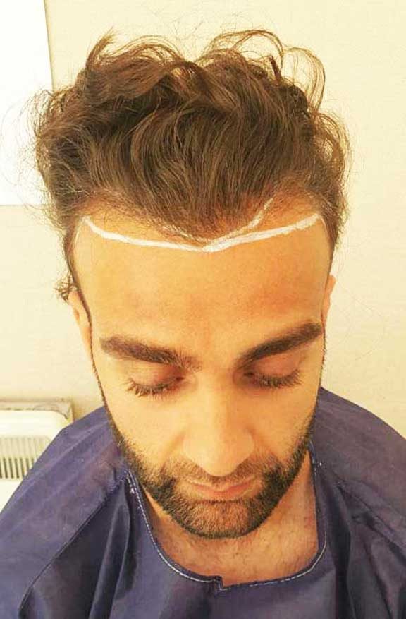 Abdul’s FUE case — the new hairline drawn before surgery