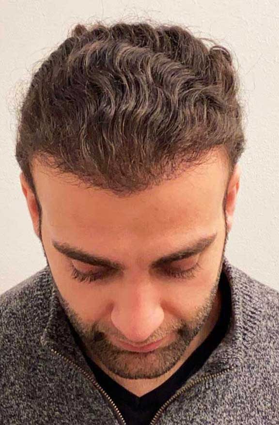 Abdul’s FUE case — new growth, photographed from above