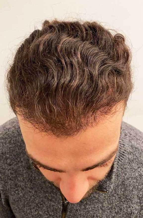 Abdul’s FUE case — the grown result, photographed from above