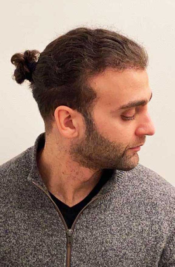 Abdul’s FUE case — the grown result, styled his way