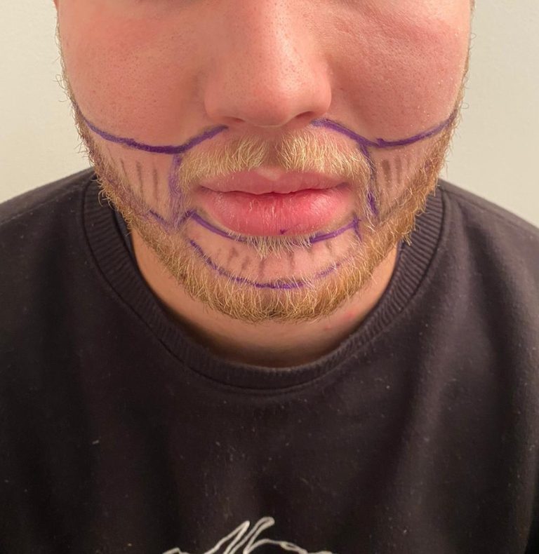 Beard transplant design markings, front view