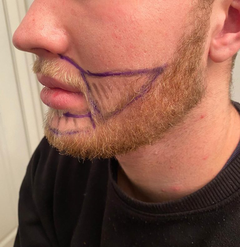 Beard transplant design markings, profile view