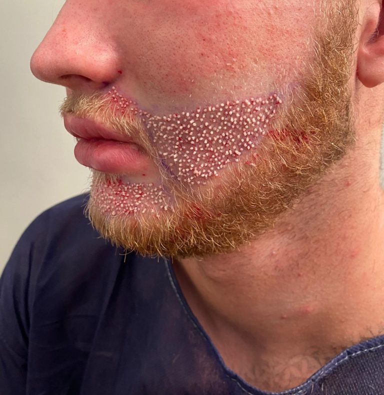 Beard grafts on the day of placement, profile view