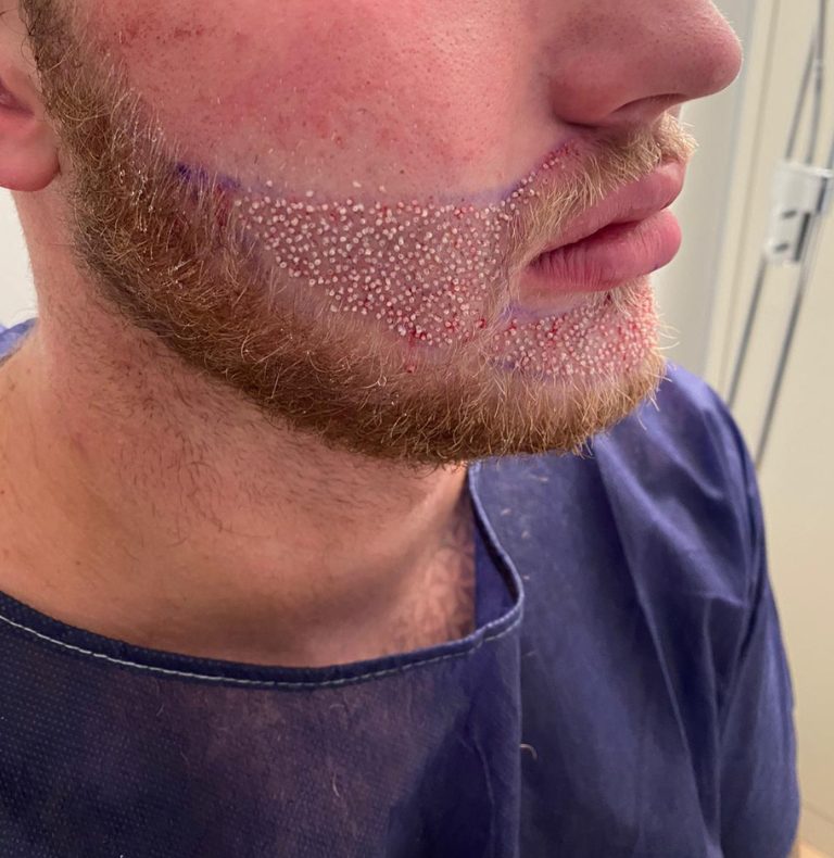 Beard grafts on the day of placement, close view