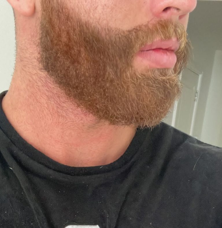 The same patient’s beard, fully grown in