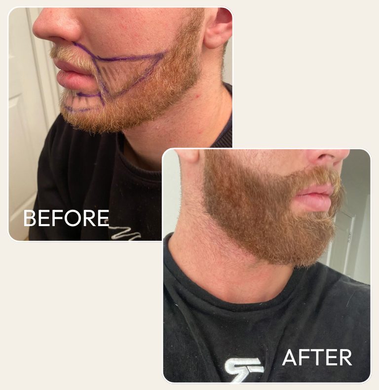 Real beard transplant patient — design markings before, full beard after