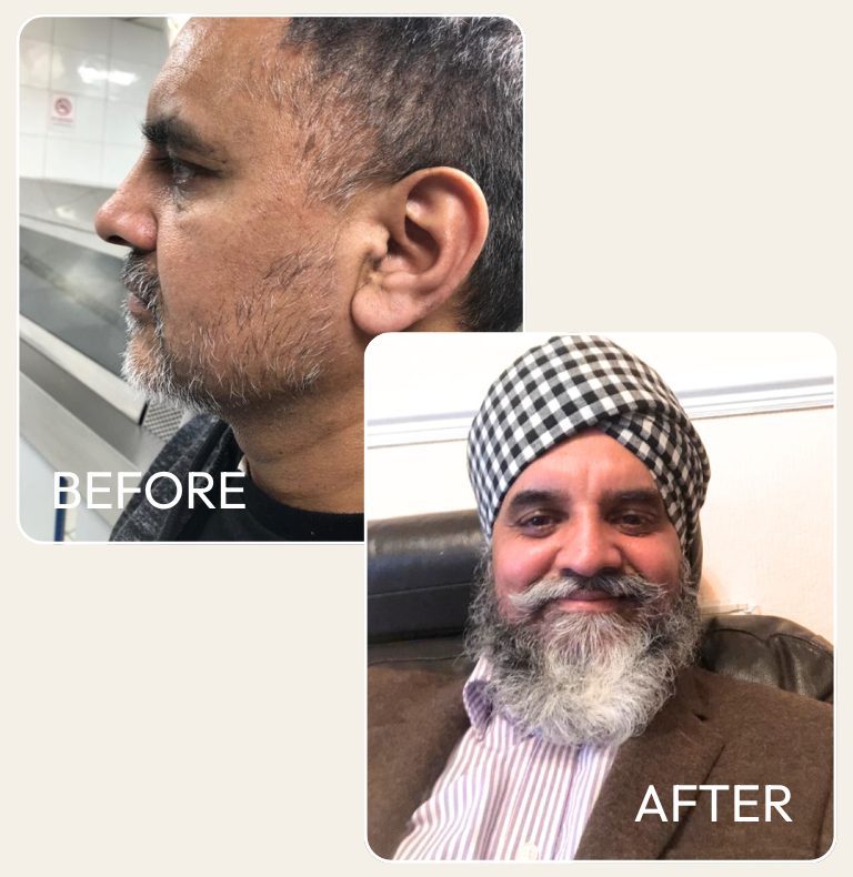 Older beard transplant patient — before in profile, full silver beard after