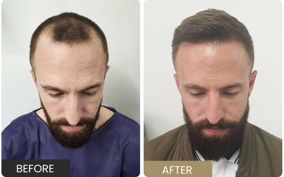 Real patient — crown and hairline photographed from above, before and after