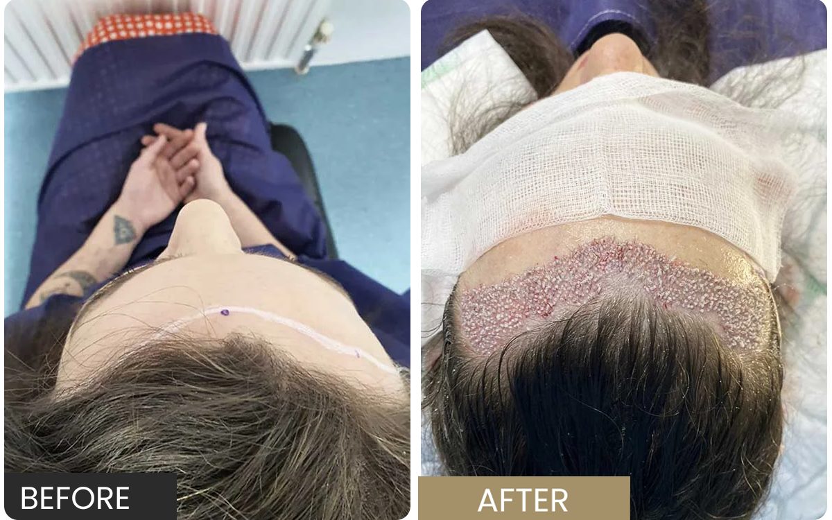 Real patient on the morning of surgery, and the moment graft placement finished