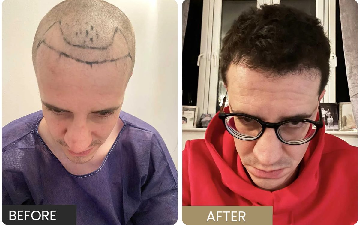 Real FUE patient — surgical design markings before, grown hairline after