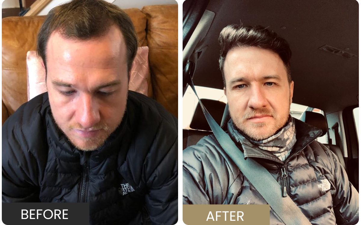 Real FUE patient — frontal recession before, restored density after