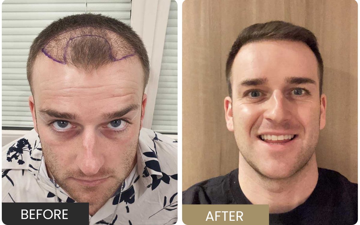 Real FUE patient — hairline design before, grown result after
