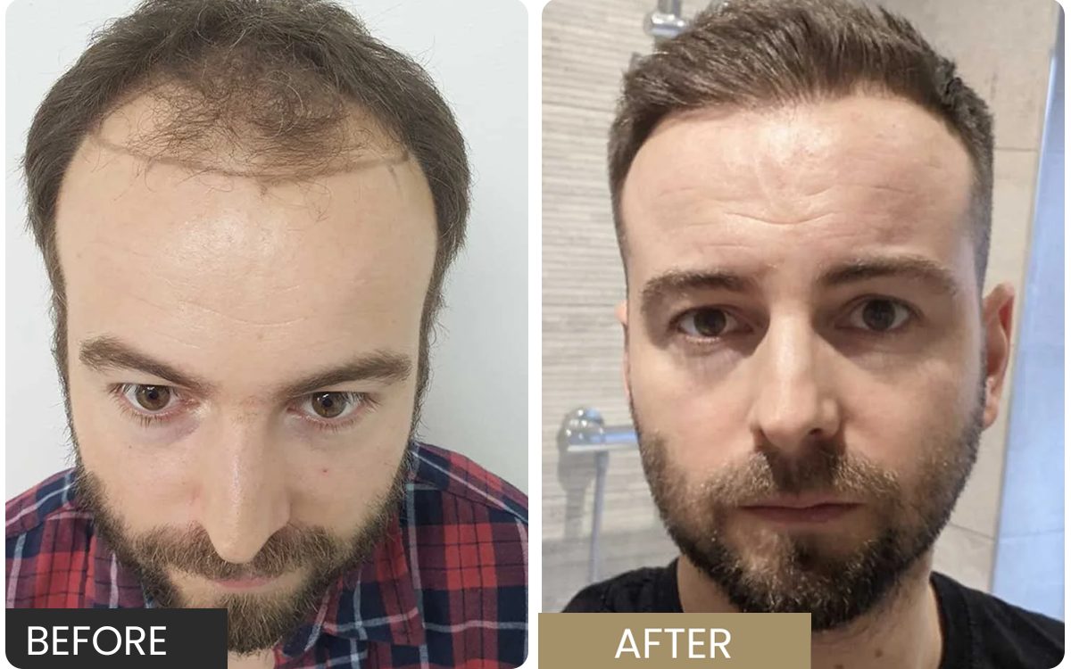 Real FUE patient — frontal and temple thinning before, restored after