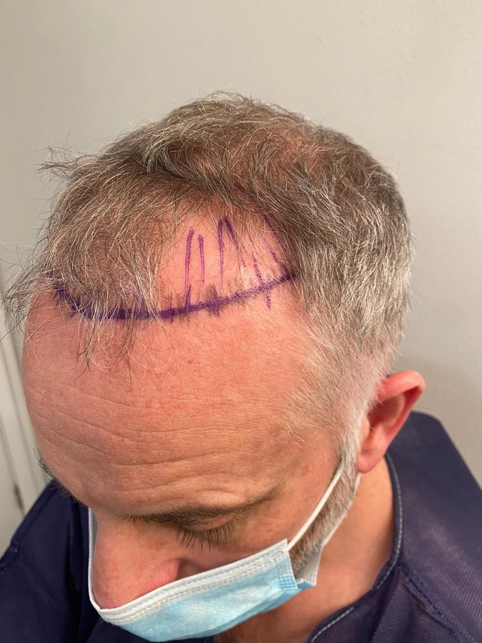 Hairline design markings drawn before FUE surgery