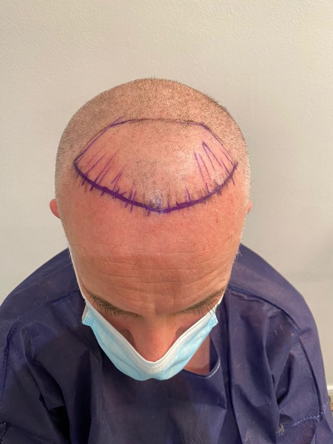 Shaved scalp with surgical hairline markings before FUE